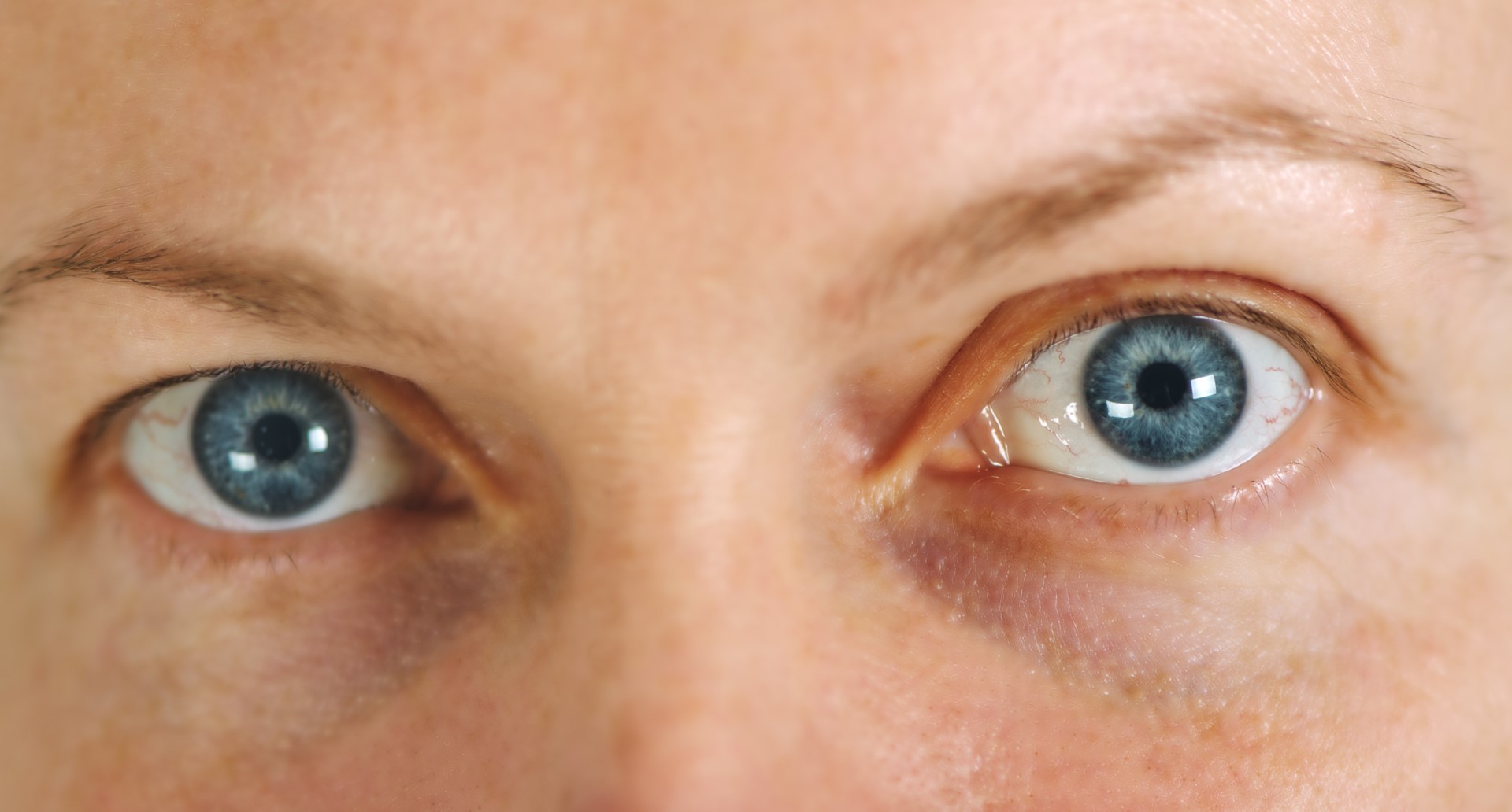 Woman with big blue eyes suffering from glaucoma, a damage in the eye optic nerve. This may lead to gradual loss of vision.