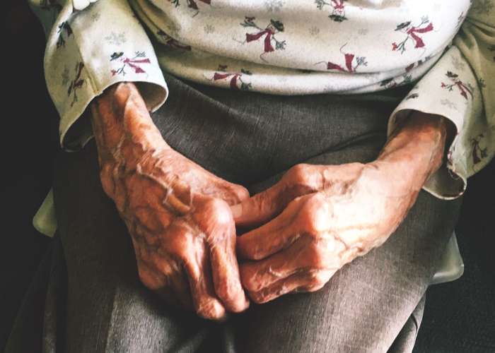 Old woman showing clear signs of arthritis in both hands, with fingers drifting away from the thumb.