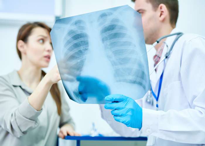 Doctor looking at chest X ray of a bronchitis patients showing over expanded lungs (hyperinflation) and flattened diaphragm.