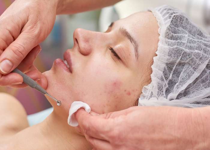 Woman suffering from black heads, doing facial treatment to remove blackheads.
