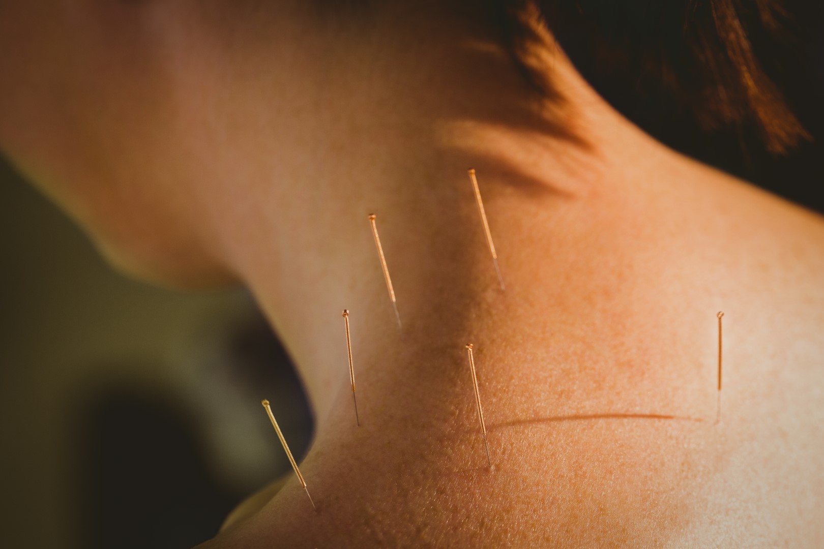 Acupuncture for chronic pain: inserting needles in acupuncture points to relieve pain.