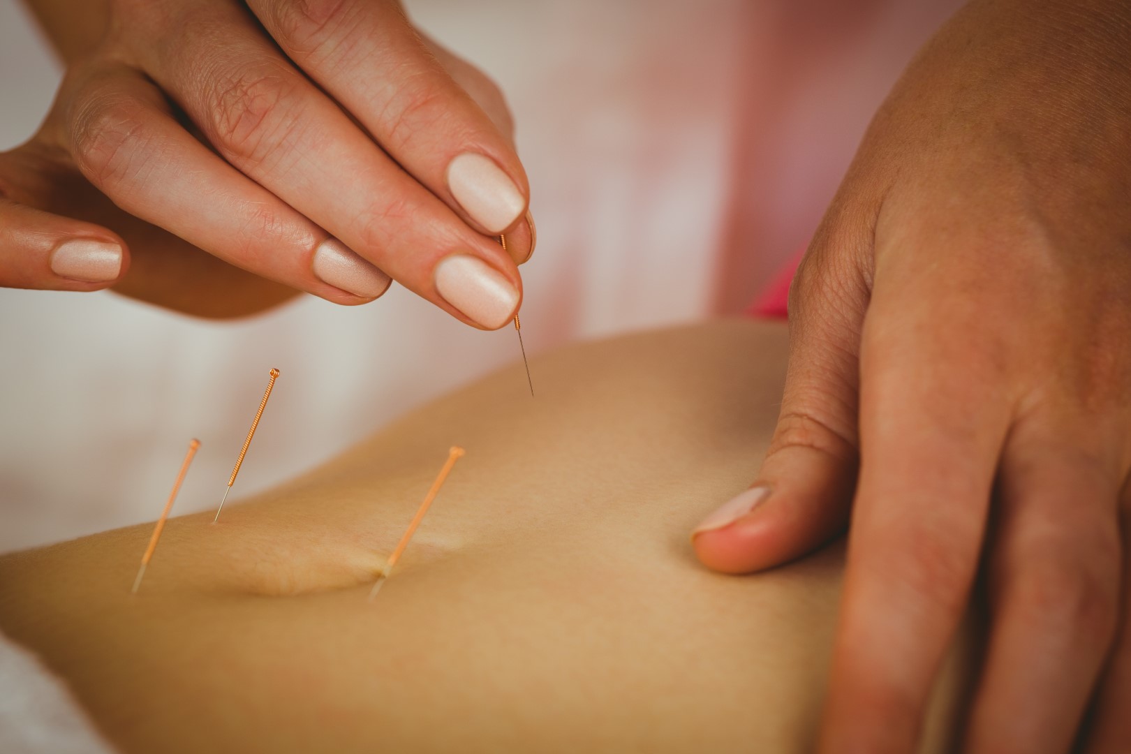 Acupuncture for digestion: Inserting needles in acupuncture points to treat digestion problems.