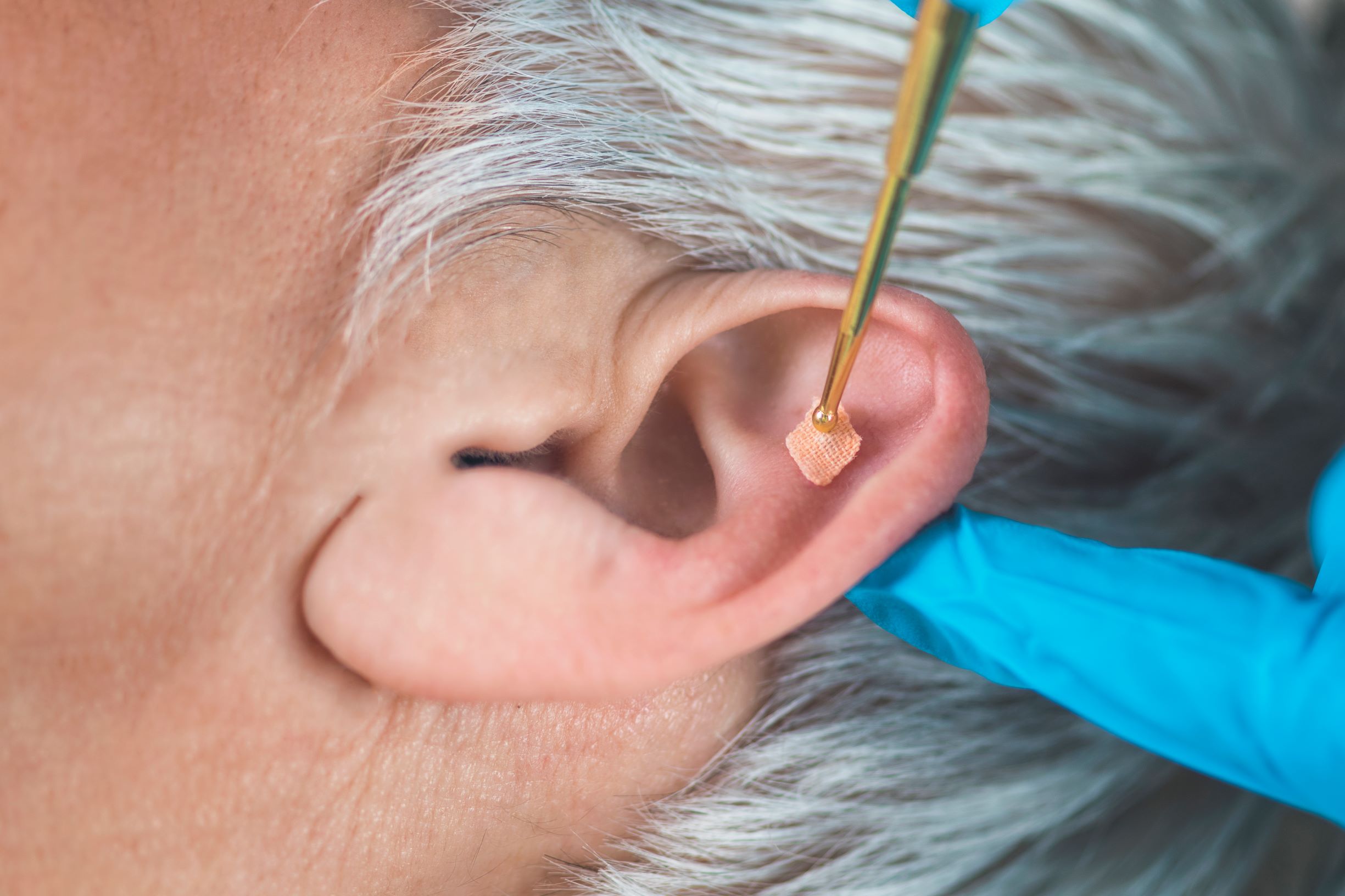 Auricular therapy for weight loss: inserting acupuncture needles in weight loss trigger points to reduce weight.