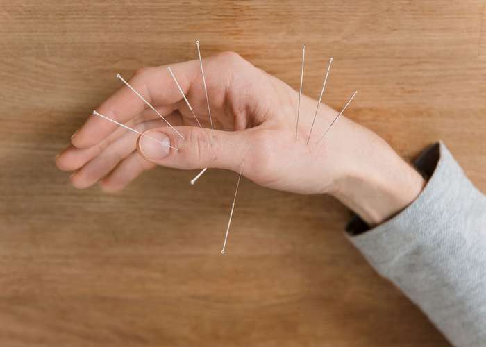 Acupuncture for arthritis: treating arthritis with needles inserted in the joints and hands to reduce inflammation.