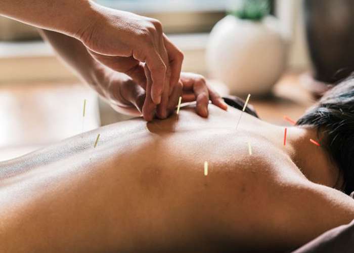 Acupuncture for headache and migraines: acupuncture needles inserted in the body to treat headaches and migraines.