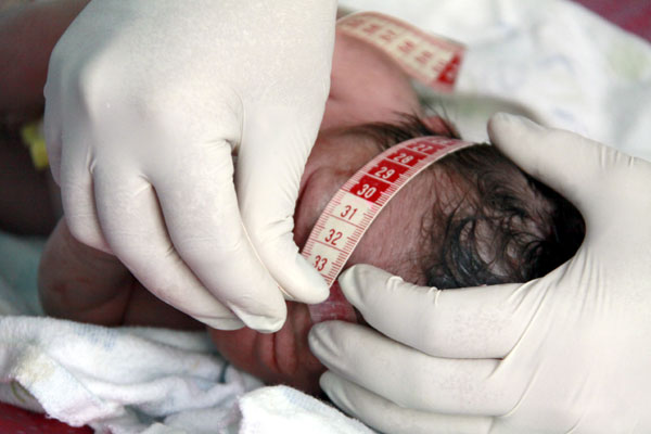 microcefalia-e-aborto