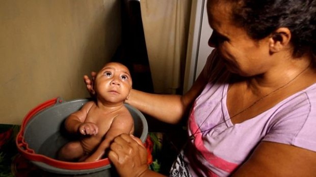 A Batalha de bebes com microcefalia para chegar ao primeiro ano de vida BBC Brasil