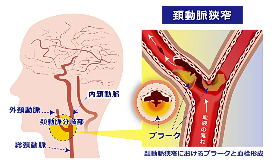 颈动脉斑块能逆转 满足3个条件 有可能