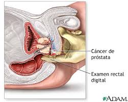 cáncer de próstata cirugía o radioterapia