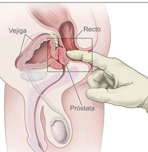 Cáncer próstata, la enfermedad silente que más amenaza a los hombres de Nicaragua