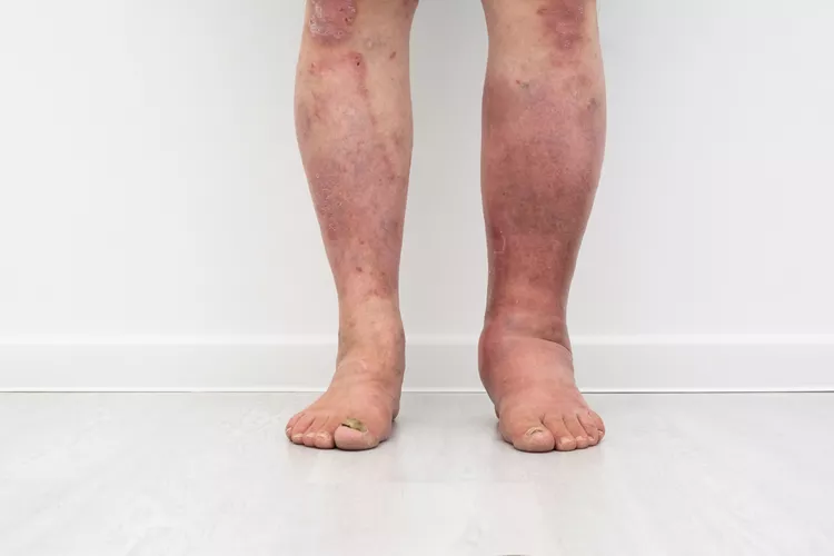 Linfedema y calor: cómo cuidar tus piernas o brazos en verano sin agravar la hinchazón