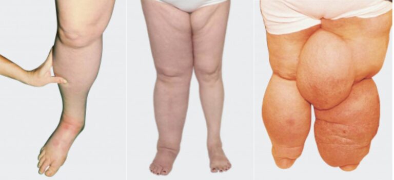 Linfedema primario y secundario: entender las diferencias para saber qué está pasando