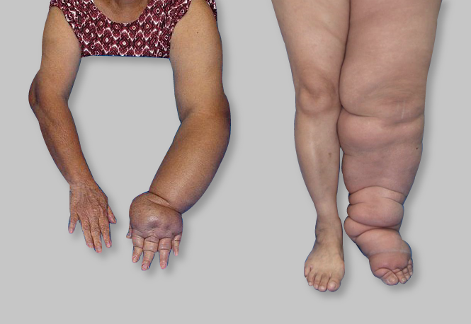 Señales iniciales del linfedema: cómo reconocer la hinchazón crónica a tiempo