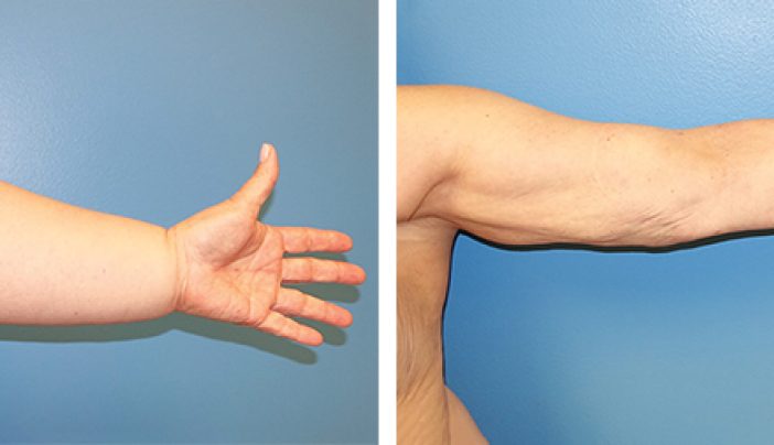 Tengo el brazo hinchado desde hace meses, ¿podría ser linfedema?