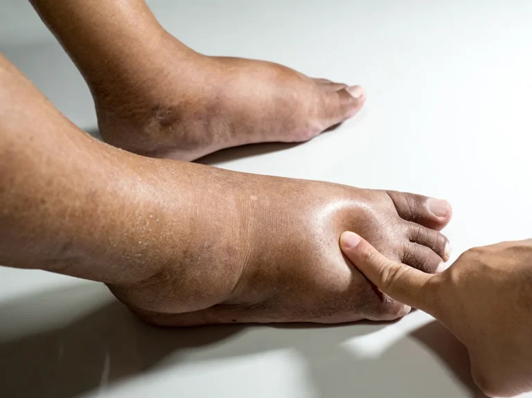 Cambios en la piel y linfedema: cuándo prestar atención sin alarmarse