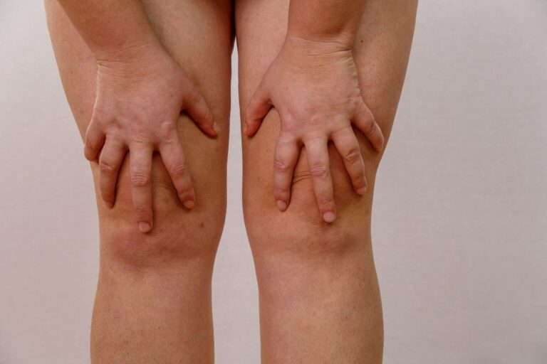 Etapas del linfedema: entender la evolución sin miedo