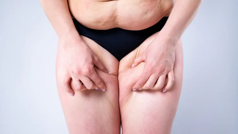 Pesadez, tirantez y dolor: síntomas frecuentes del linfedema que no debes ignorar