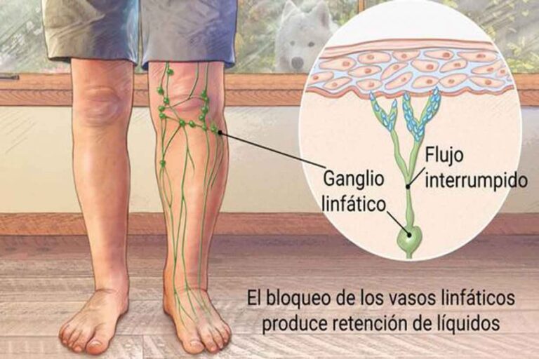 Linfedema e infecciones recurrentes: cómo prevenir erisipela y celulitis