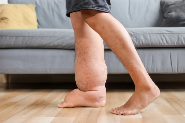 Vivir con linfedema en el día a día: pequeños hábitos que marcan la diferencia