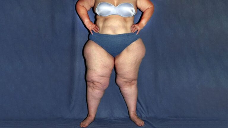 Lipedema: ¿Estamos cerca de una revolución terapéutica? Claves sobre el futuro del tratamiento