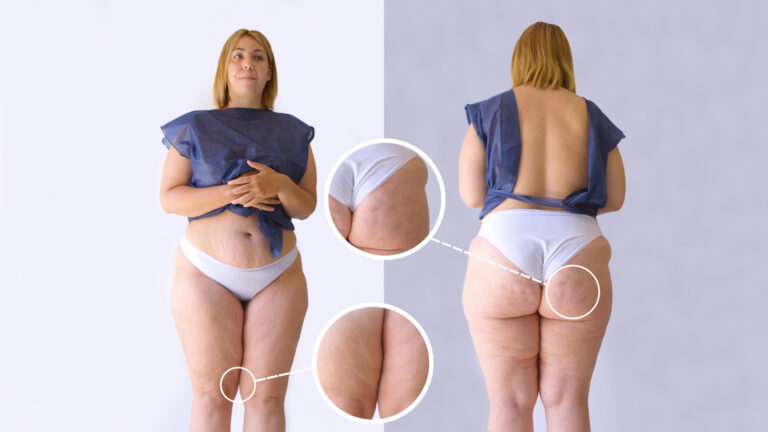 Lipedema y atención sanitaria: ¿por qué muchas mujeres aún reciben cuidados inadecuados?