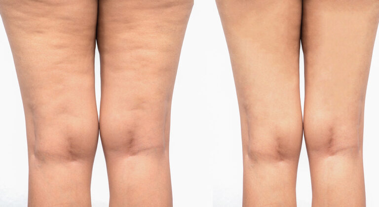 Signos ignorados del lipedema: dolor y hematomas que no deberías pasar por alto