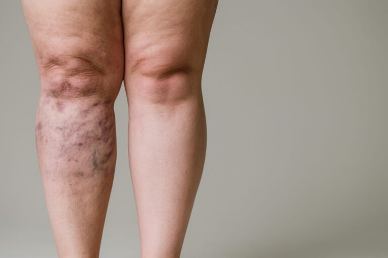 “Tú lo que tienes es obesidad”: errores frecuentes en el diagnóstico del lipedema