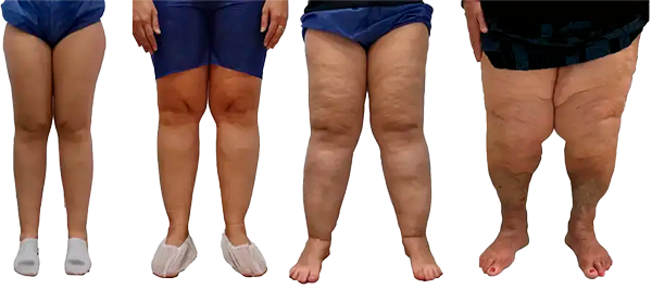 Errores comunes en el diagnóstico del lipedema y cómo evitarlos