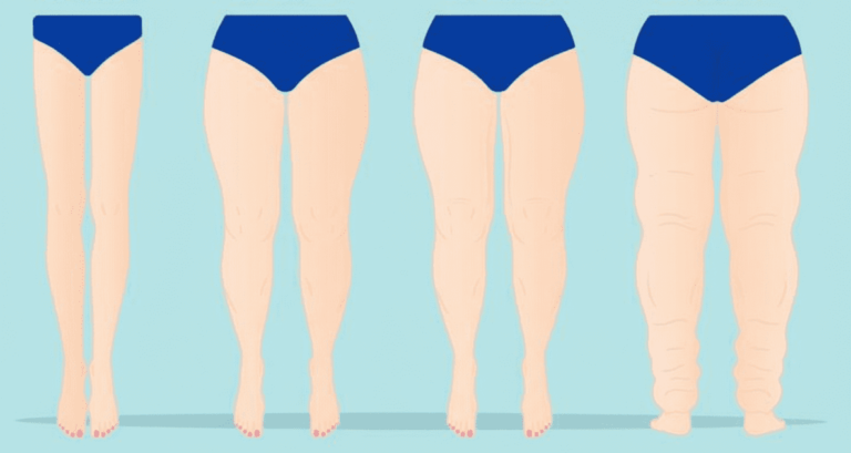 Etapas del lipedema: cómo cambia con el tiempo si no se trata