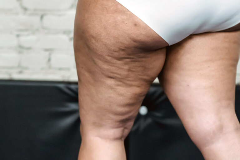 Dietas milagro y soluciones rápidas en lipedema: qué debes saber