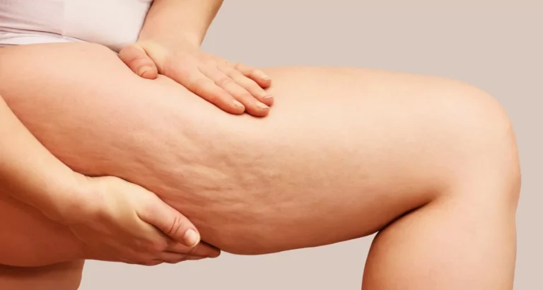 Lipedema no es celulitis: diferencias que conviene conocer