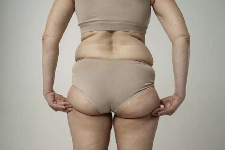 “Si adelgazo se me quitará”: desmontando uno de los mitos del lipedema