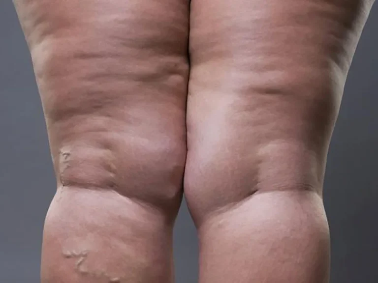 Cuando el lipedema limita tu movilidad: señales que no debes ignorar