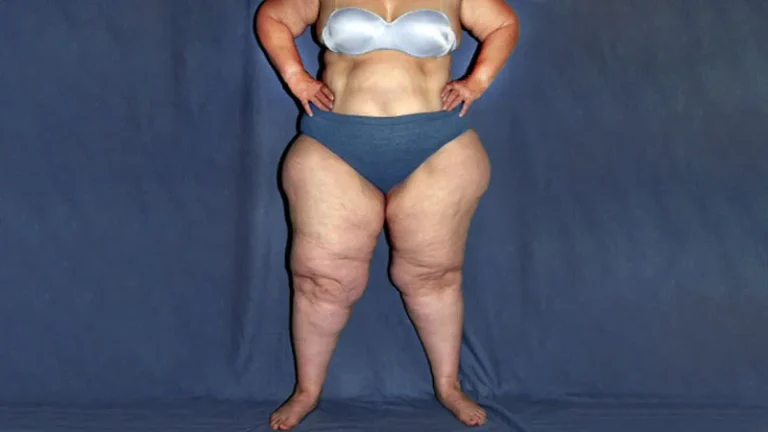 Lipedema y dolor crónico: estrategias fisioterapéuticas para mejorar calidad de vida sin sobrecargar el cuerpo
