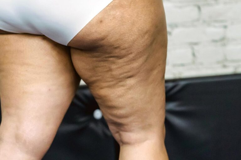 Por qué el ejercicio de impacto puede empeorar el lipedema y qué alternativas recomienda la fisioterapia