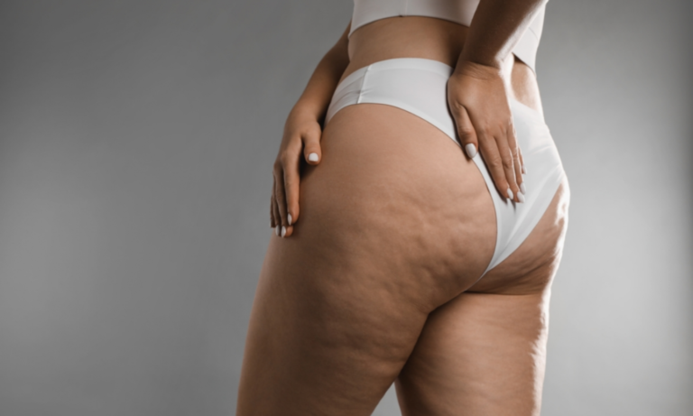 ¿Tengo lipedema o es otra cosa? Guía básica para salir de dudas