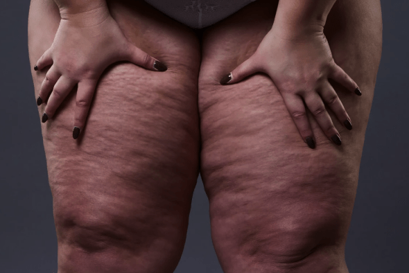 Cómo reducir la sensación de inflamación del lipedema en tu día a día