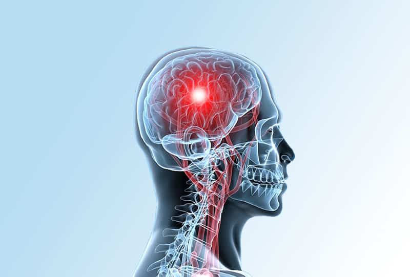 Accidente Cerebrovascular Acv Definición Tipos Y Tratamiento